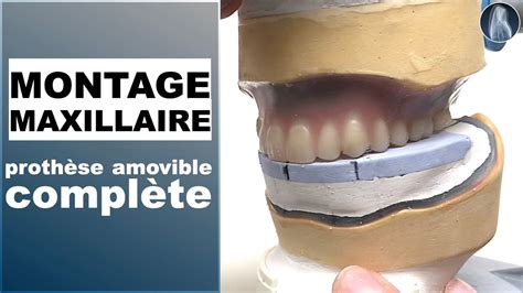 Apprenez à monter les dents maxillaires sur une table personnalisée