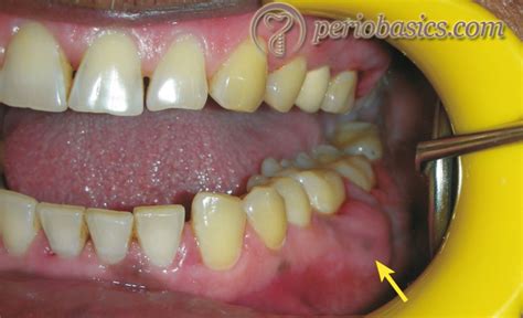 Periodontal Abscess Radiograph