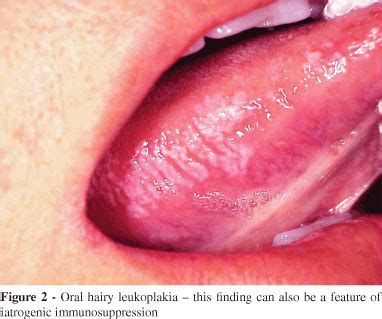 Hiv Symptoms On Lips