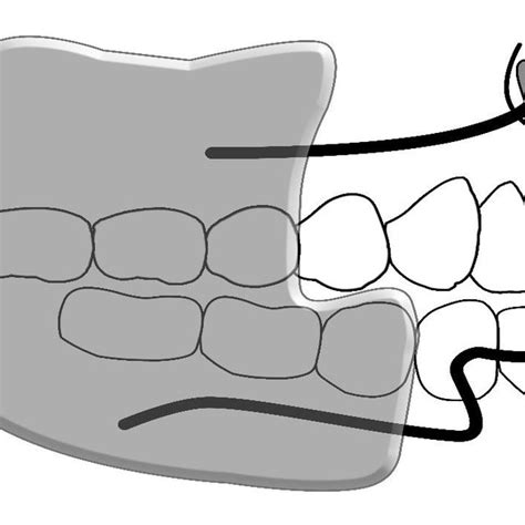 Schematic View Of Bionator Iii Appliance Download Scientific Diagram