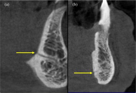 Lingual foramen positioned (a) superior and (b) inferior to the genial ...