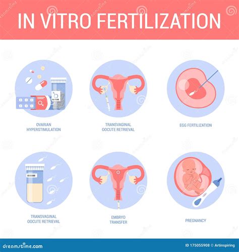 In Vitro Fertilization Step By Step Method Idea Of Infertility Stock