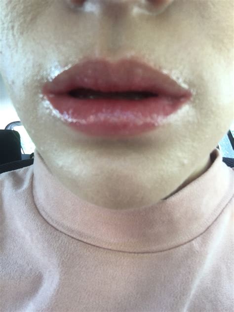 Accutane Side Effects Lips