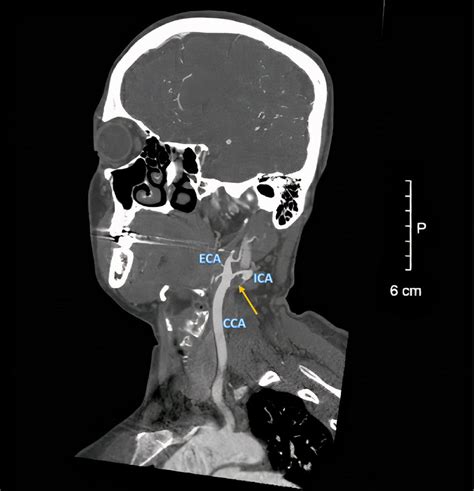 Sagittal Ct Of The Neck Showing The Branches Of The Patient S Left Cca