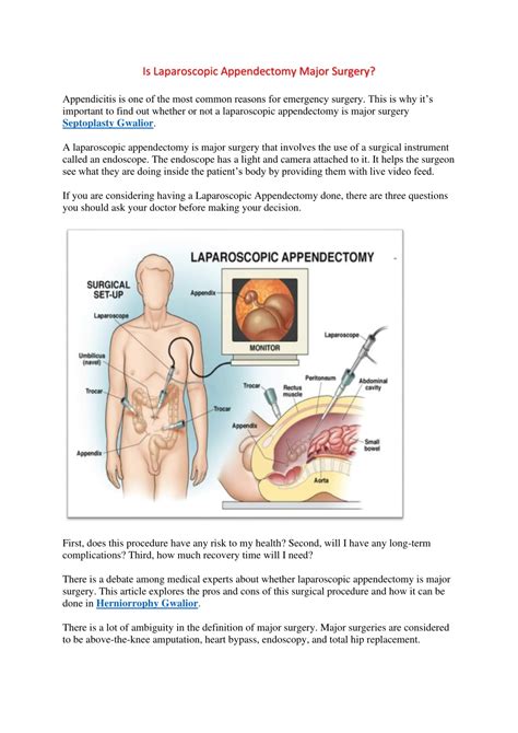 PPT Is Laparoscopic Appendectomy Major Surgery PowerPoint