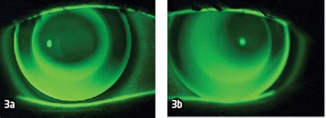 Experiences Of Orthokeratology Revealing Case Studies Optician