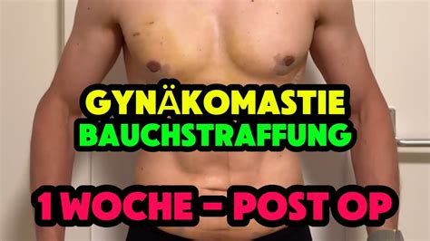 Eine Woche Nach Meiner Gyn Komastie Und Bauchstraffung Youtube