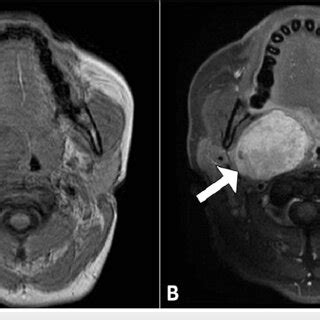 Axial And Coronal T1 Weighted MR Images Of The Neck Demonstrate A Low