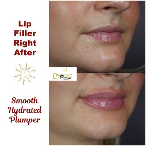 Lip Fillers Charmed Medispa