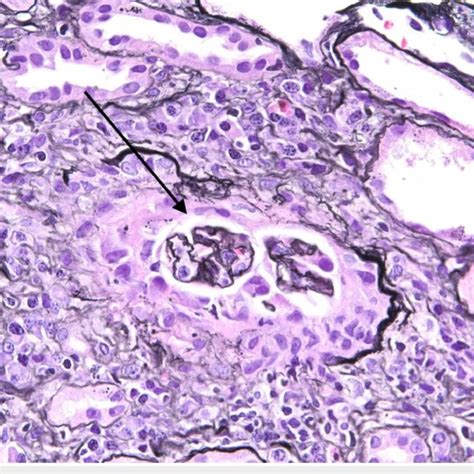 Light Microscopy Of Renal Biopsy Two Of Six Non Sclerotic Glomeruli