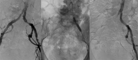 Acute And Chronic Ischaemia Of The Lower Limb Surgery Oxford