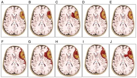 Radiological Classification Of Meningiomas With Hemorrhagic Onset And