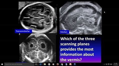 Cerebellar Vermis Fetal Ultrasound