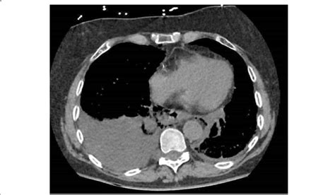 Pleural Effusion On CT Scan