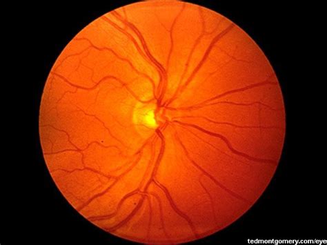 normal fundus