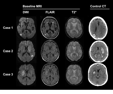 Intracerebral Hemorrhage Mri