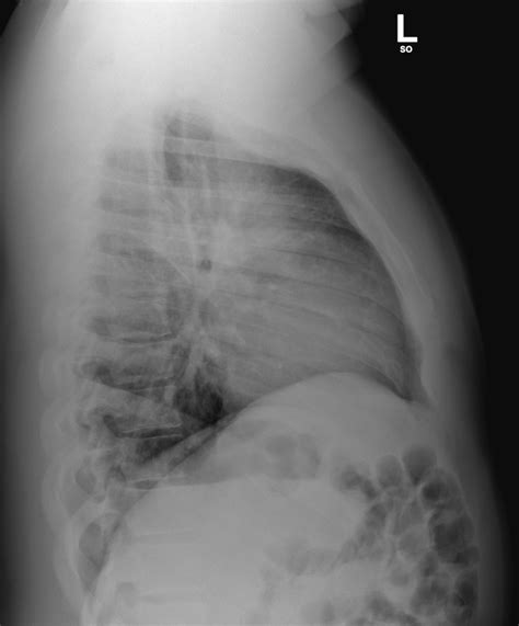 Left Upper Lobe Consolidation Image Radiopaedia Org