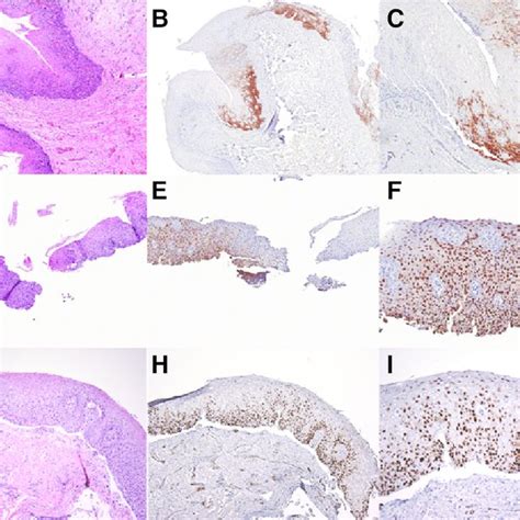 Expression Of Cancer Testis Antigens In Noninvasive Squamous Neoplasm