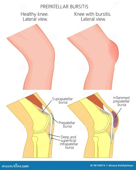 Knee Bursitis Prepatellar Bursitis Stock Vector Illustration Of