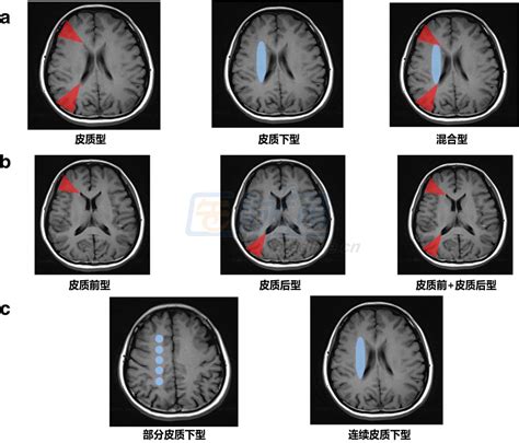 脑分水岭梗死从分型到临床诊治都在这里了 中华医学网 131