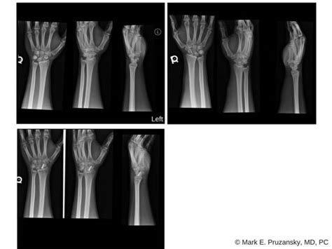 Scaphoid Non-Union Surgery | New York, NY