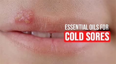 ️top 10 Essential Oils For Cold Sores Healthtostyle