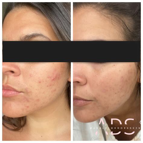 Huntsville Al Acne Bootcamp Clear Skin Starts Here — The Tailored