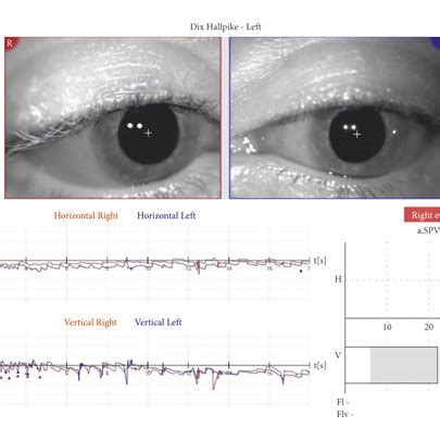 Right-sided Dix–Hallpike test performed during the follow-up exam a... | Download Scientific Diagram