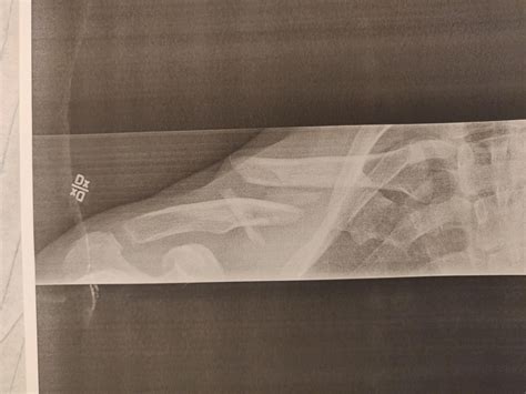 Tips for where to buy Exogen or other LIPUS ultrasound bone healing