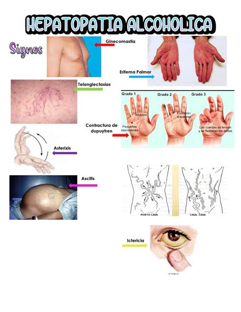 Semio Cirrosis Contractura De Dupuytren Ginecomastia Eritema Palmar