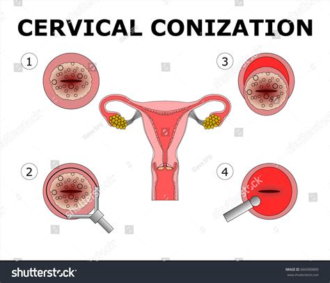 Cervical Conization Vector Color Illustration Stock Vector (Royalty ...