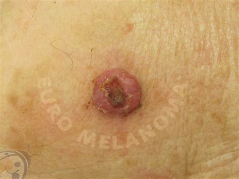 Merkel Cell Carcinoma Euromelanoma