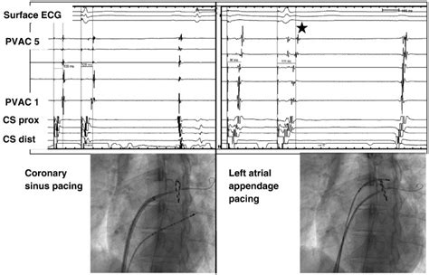 Duty Cycled Unipolar Bipolar Versus Conventional Radiofrequency