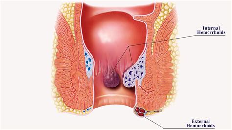 Haemorrhoids Information