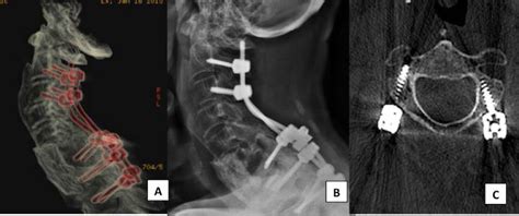 Scielo Brasil Axis Screws Results And Complications Of A Large Case