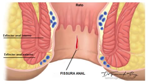 Fissura Anal O Que Causas Sintomas Tratamento