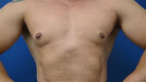 D Gynecomastia Pre Procedure Youtube