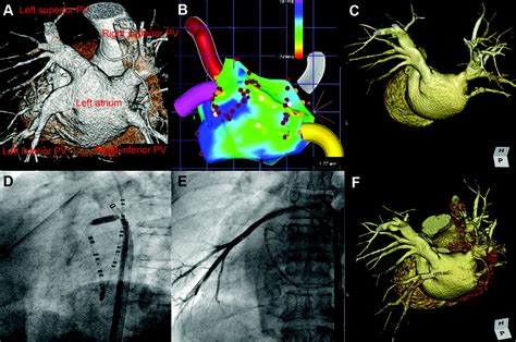 Pulmonary Vein Obstruction After Catheter Ablation Following Atrial Fibrillation Circulation