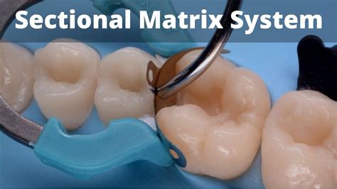 Class 2 Restoration Molar Premolar Sectional Matrix Tips Tricks