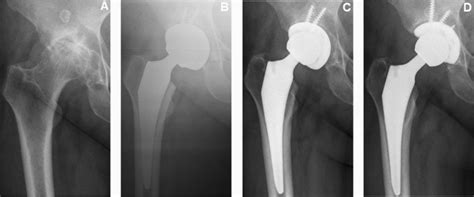 Serial Radiographs Of One Of The Two Acetabular Aseptic Loosening Download Scientific Diagram