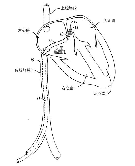 Methods and apparatus for treatment of patent foramen ovale - Eureka