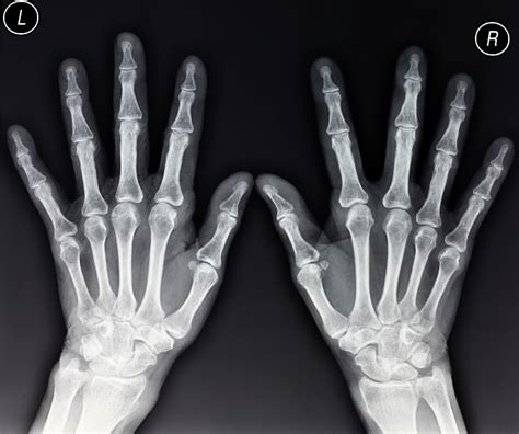 Top 93 Pictures Normal X Ray Of Hand And Wrist Sharp