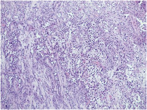 Squamous Cell Carcinoma Histology