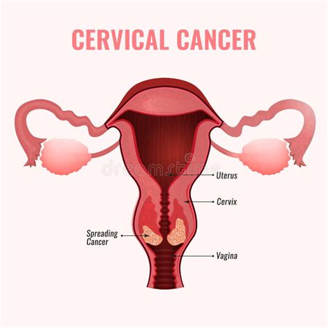 Diagrama Del Cáncer De Cuello Del útero Con El Personaje De Dibujos Animados Del útero De La