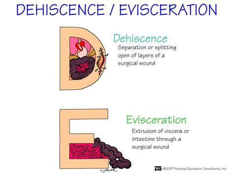 Dehiscence And Evisceration When The Rn Assesses The Incision Of A