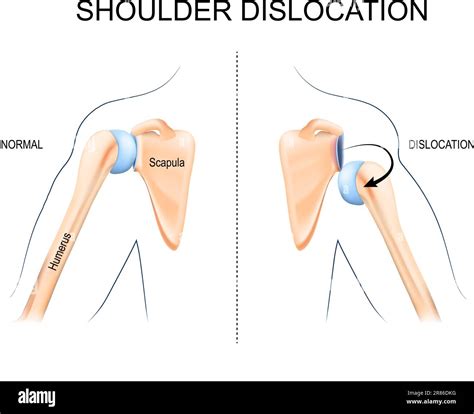 Luxation de l épaule Traumatisme osseux de l humérus blessures