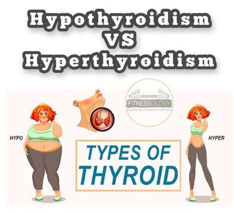 Hypothyroidism vs. Hyperthyroidism: What’s the Difference? – Fitnessology