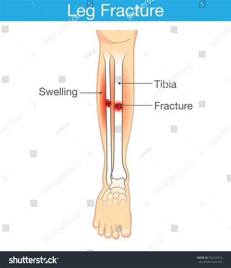 Diagram Leg Have Bone Fracture This Stock Vector (Royalty Free ...