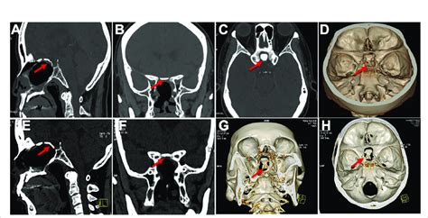 Displayed In Situ Bone Flap Postoperatively In 3d Reconstruction A D Download Scientific