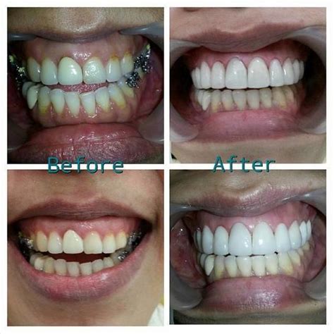 Facelift Dentures Before And After